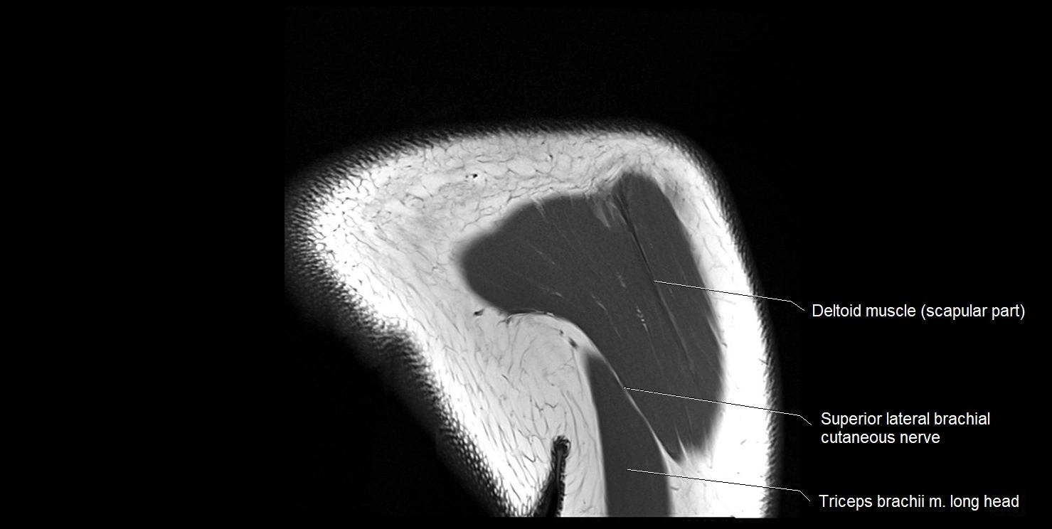 mri shoulder coronal cross sectional anatomy image 20.webp